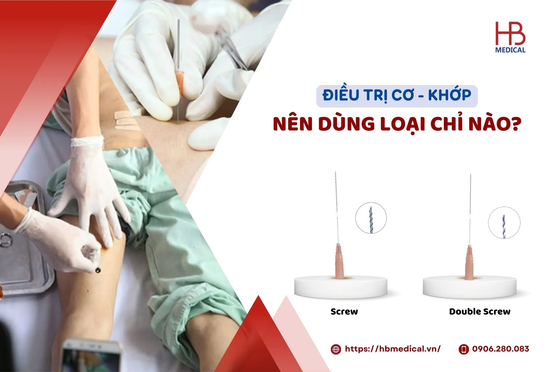 Điều trị cơ - khớp nên dùng loại chỉ nào?