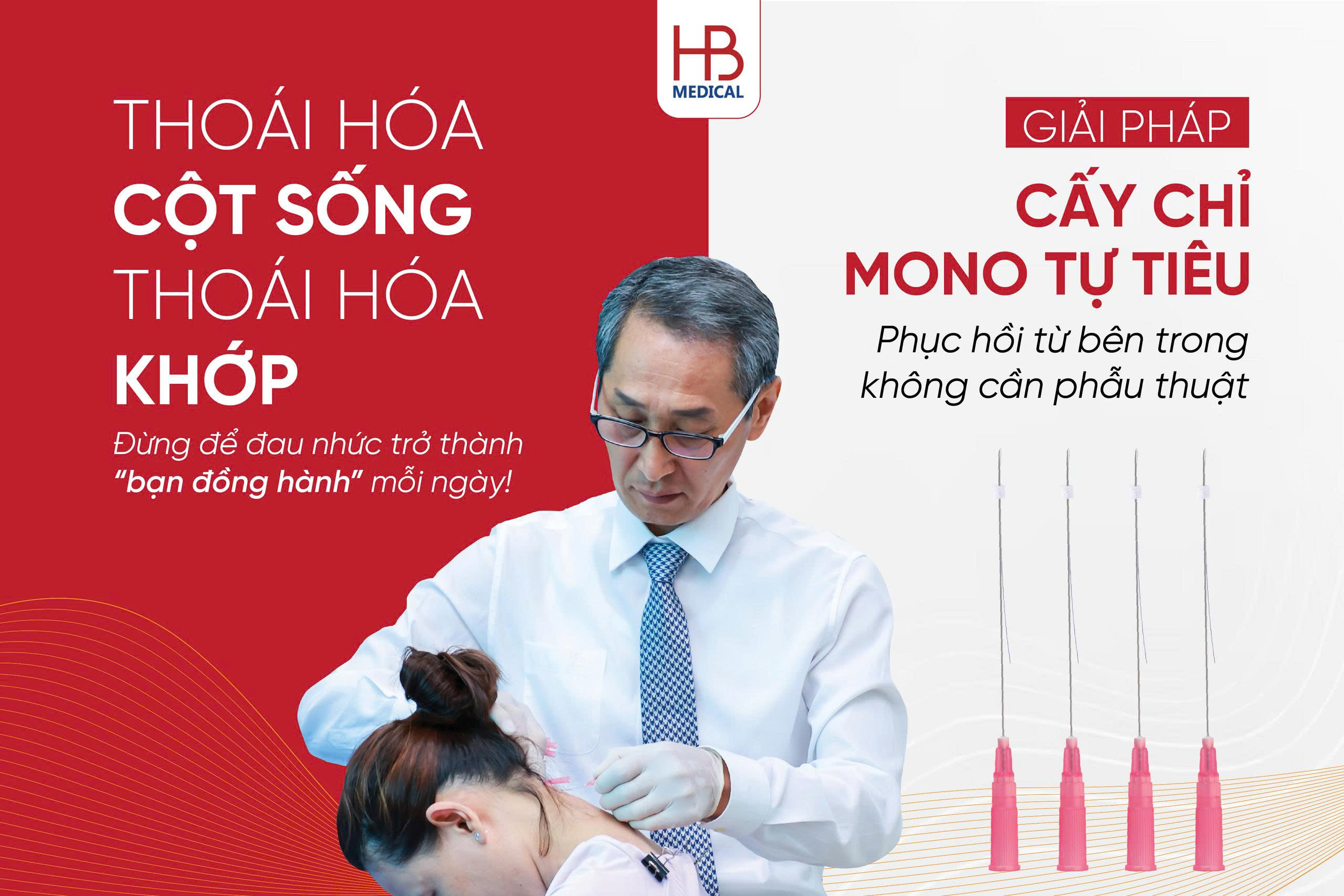 Chỉ Mono – Giải pháp cấy chỉ chữa bệnh xương khớp