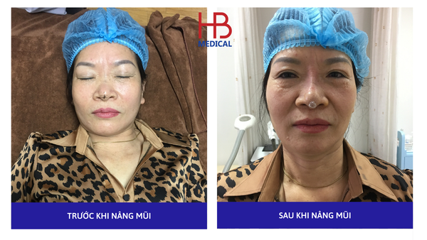 Nâng mũi S-line sau 30 phút với chỉ Super Hi Mico