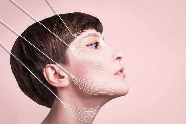 Những sự thật về căng chỉ collagen có thể bạn chưa biết