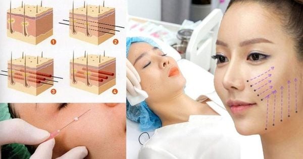 Những điều cần biết về căng da mặt bằng chỉ
