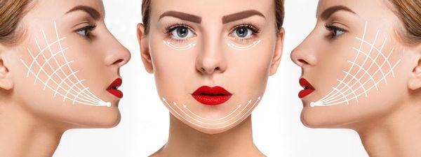 Căng da mặt bằng chỉ collagen: Giải pháp thẩm mỹ hiệu quả, an toàn và tiết kiệm