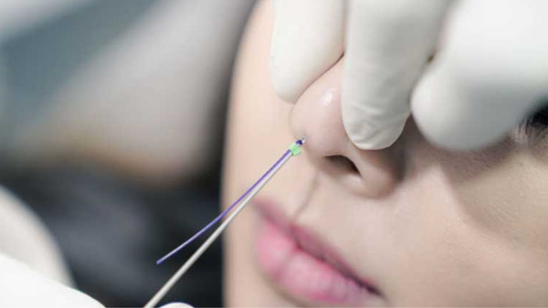 Nâng mũi bằng chỉ - 10 câu hỏi thường gặp và giải đáp từ chuyên gia