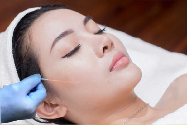 Căng chỉ collagen bao nhiêu tiền? Những yếu tố quyết định chi phí