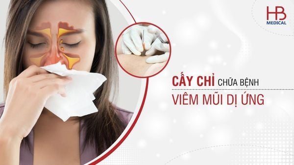 Cấy chỉ chữa bệnh viêm mũi dị ứng có hiệu quả không?