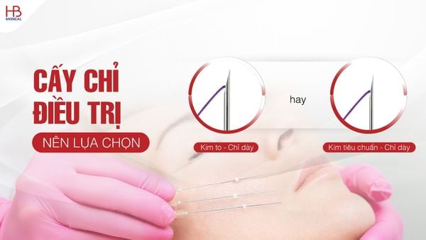 Cấy chỉ điều trị - Nên lựa chọn kim to, chỉ dày hay kim tiêu chuẩn, sợi chỉ dày?