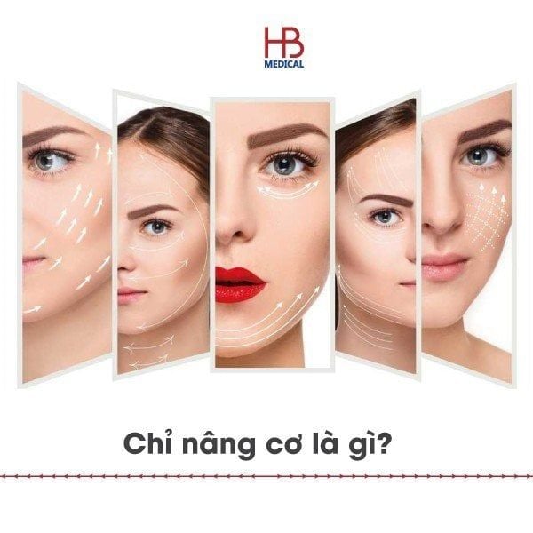 Chỉ nâng cơ là gì? Trẻ hóa an toàn với chỉ thẩm mỹ