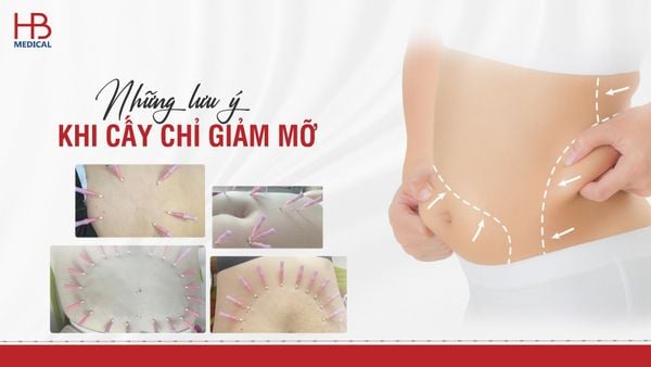 Những lưu ý khi cấy chỉ giảm béo