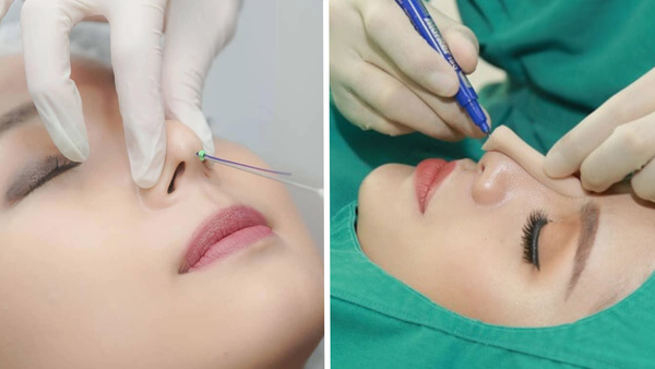Nên căng chỉ nâng mũi hay phẫu thuật nâng mũi?
