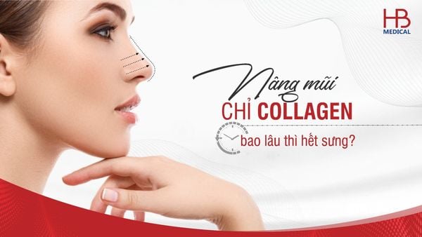 Nâng mũi chỉ collagen bao lâu thì hết sưng?