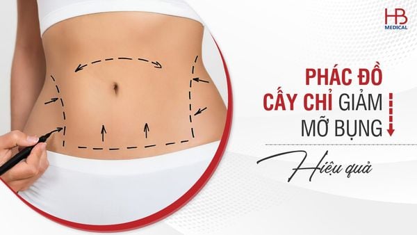 Phác đồ cấy chỉ giảm mỡ bụng hiệu quả