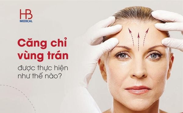 Căng chỉ vùng trán được thực hiện như thế nào?